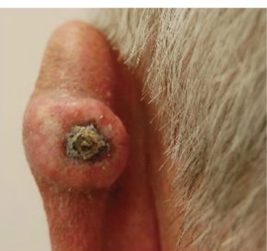 <p>Ulcerated Basal Cell Carcinoma: non-healing ulcer, resulting in rolled border/edge</p><p>MIMIC: SCC</p><ul><li><p>may be ulcerated</p></li><li><p>on exam edges FIRMER to palpation than BCC</p></li></ul><p></p>