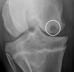 <p>Subchondral cystic lesions secondary to osteochondosis.</p>