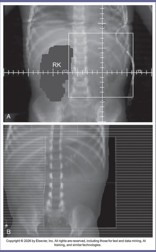 <ul><li><p>nephrectomy</p></li><li><p>chemo</p></li><li><p>radiation (3D conformal with MLCs to block healthy kidney)</p></li></ul><p></p>