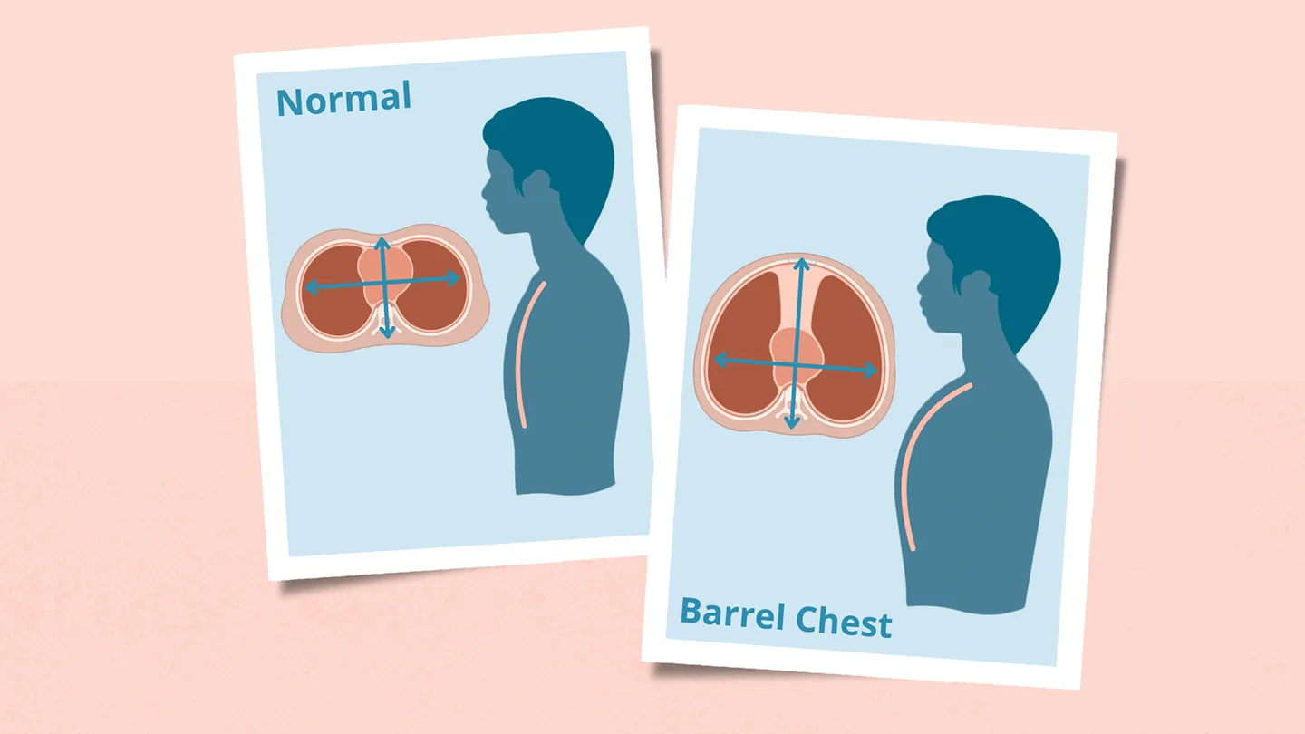 <p>increased AP diameter (0.9+)</p><p>infancy+aging→normal</p><p>adults→I: COPD</p>