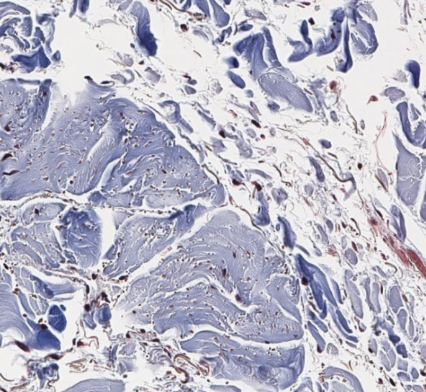 <p>what type of CT is seen outside the lobules (red areas)?</p>