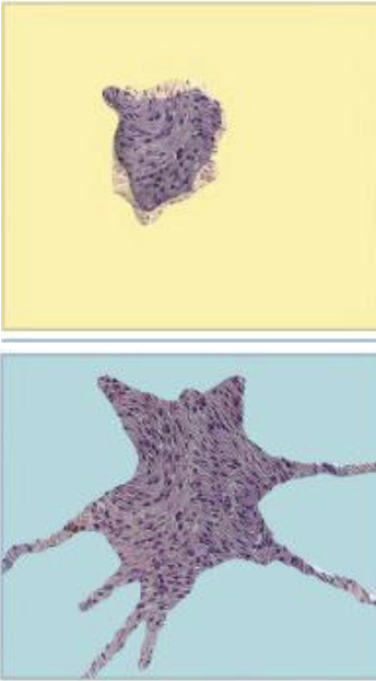 <p>It evaluates the amount of tissue surrounding the tumor that is <strong>free of tumor</strong> and helps determine whether the tumor was completely removed</p>