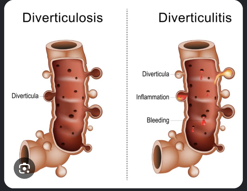 <p>Etiology </p><ul><li><p>Associated factors include alterations in colonic wall resistance, alterations in colonic motility, low-fiber diets, NSAID use, advanced age, obesity, and lack of exercise </p></li></ul><p>Manifestations</p><ul><li><p>sudden, constant abdominal pain in Left lower quad</p></li><li><p>Abdominal distention and nausea</p></li><li><p>Diarrhea, constipation, decreased appetite</p></li><li><p>Fever, tachycardia, hypotension </p></li></ul><p>Diverticula </p><p>Diverticulosis</p><p>Diverticulitis </p>