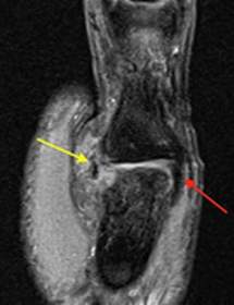 <p><span>Collateral Ligament Tears</span></p>
