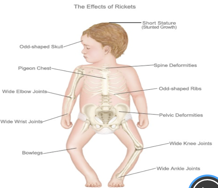 <p>disease of childhood characterized by weak and soft bones.</p>