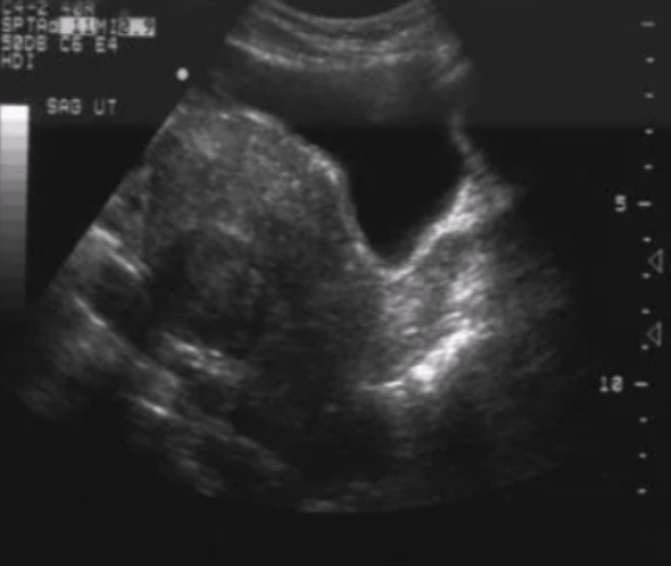 <p>Name the type of fibroid and its location</p>