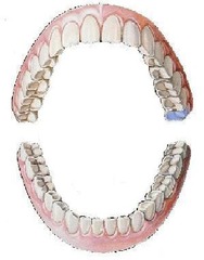 <p>maxillary left third molar</p>