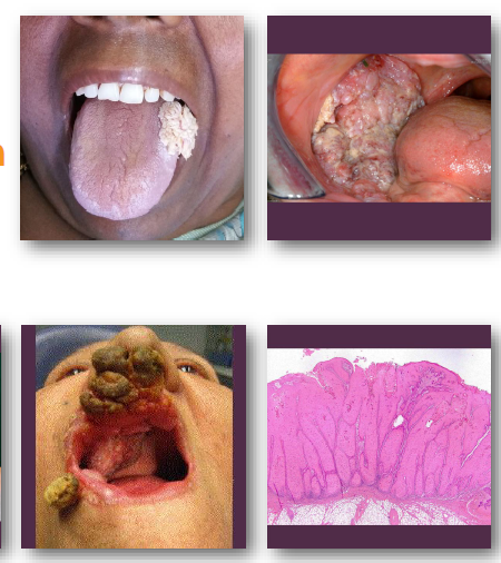 <p><strong>•Thick white verrucous or papillary mass lesion</strong></p><p>•Broad-based lesion with<strong> slow enlargement</strong></p><p><strong>•Often involves buccal mucosa or gingiva</strong></p><p>•Surface appears<strong> rough and warty (verrucous)</strong></p><p>•Typically painless in early stages</p>