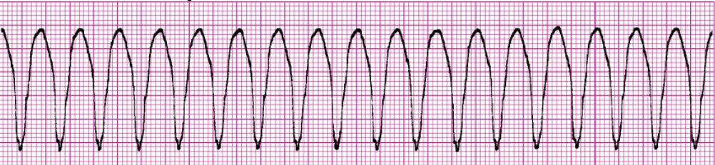 <ul><li><p><span style="background-color: transparent;">Ectopic ventricular site takes over as pacer</span></p></li><li><p><span style="background-color: transparent;">Fires at a rapid rate >100 bpm</span></p></li><li><p><span style="background-color: transparent;">QRS >0.12 sec</span></p></li><li><p><span style="background-color: transparent;">Can have a pulse or be pulseless</span></p></li><li><p><span style="background-color: transparent;">Tx</span></p><ul><li><p><span style="background-color: transparent;">Check pulse</span></p></li><li><p><span style="background-color: transparent;">If pulse present, prepare for sedation and cardioversion</span></p></li><li><p><span style="background-color: transparent;">If no pulse present</span></p><ul><li><p><span style="background-color: transparent;">CPR and immediate defibrillation</span></p></li><li><p><span style="background-color: transparent;">Epinephrine 1 mg q 3-5 min</span></p></li><li><p><span style="background-color: transparent;">Additional shocks prn immediately followed by CPR</span></p></li></ul></li><li><p><span style="background-color: transparent;">Lidocaine, amiodarone&nbsp;</span></p></li></ul></li></ul><p></p>