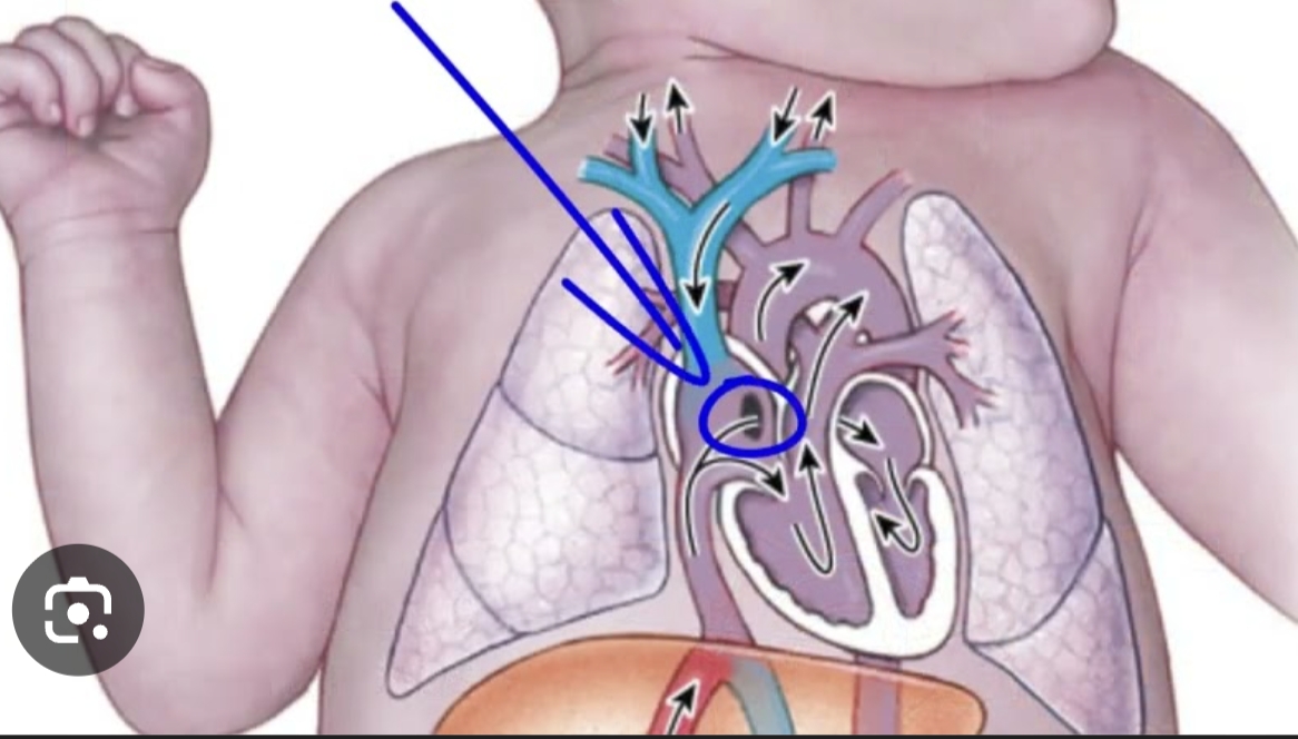 <p>An opening in the fetal heart that allows blood to flow from the right atrium to the left atrium, bypassing the lungs</p><p>Turns into <strong>Fossa Ovalis</strong></p>