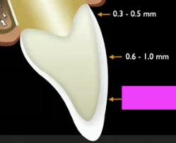<p>How much enamel do you have incisally?</p>