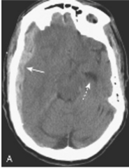 <p>- crescent-shaped</p><p>- extra cerebral bands of high attenuation that may cross suture lines and enter the interhemispheric fissure</p><p>- do not cross the midline (but can cause mass effect)</p>