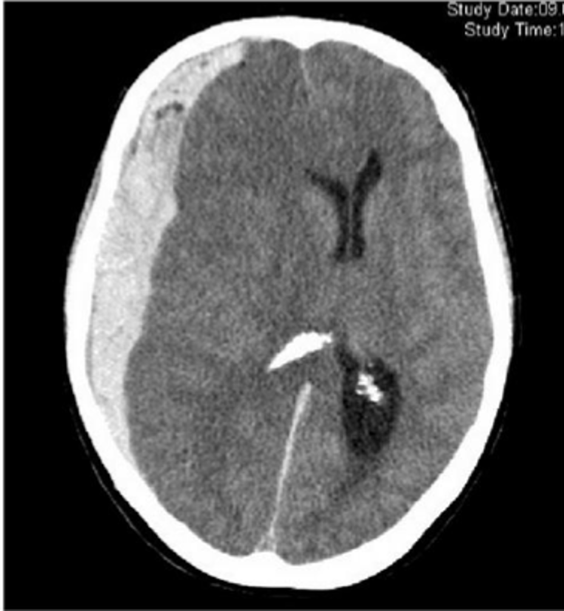 <p>occurs when the midline is shifted R or L</p><p>causes: inter cranial pressure, TBI, stroke, tumor, abscess</p>