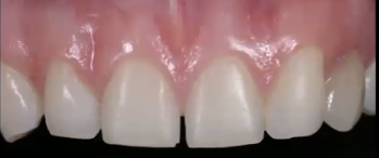 <p>What are some reasons why you’d want to close the diastema?</p>