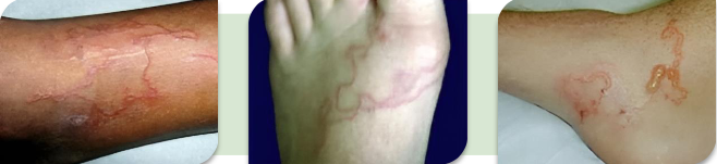 <p>Producida por larvas de ancilostómidos <strong>(ancylostoma spp)</strong> de perros y gatos. Es un fenómeno cutáneo por penetración activa. El humano actúa como huésped accidental.<br><br>La lesión corresponde a la migración intradérmica de la larva que genera trayecto serpiginoso, eritematoso y sobreelevado con prurito intenso.</p>