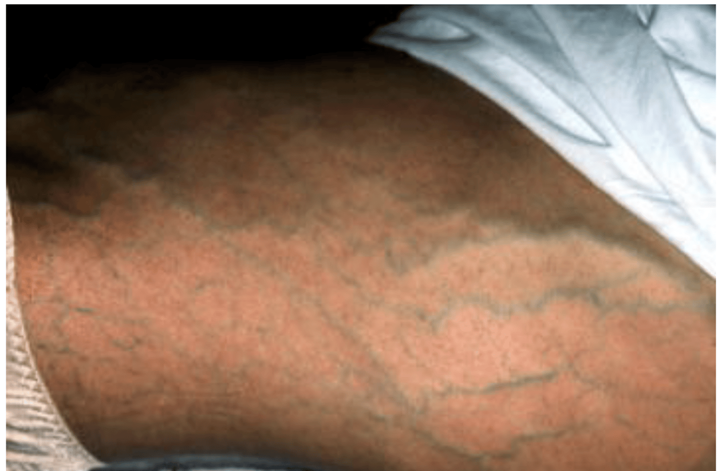 <p>dilated veins</p>