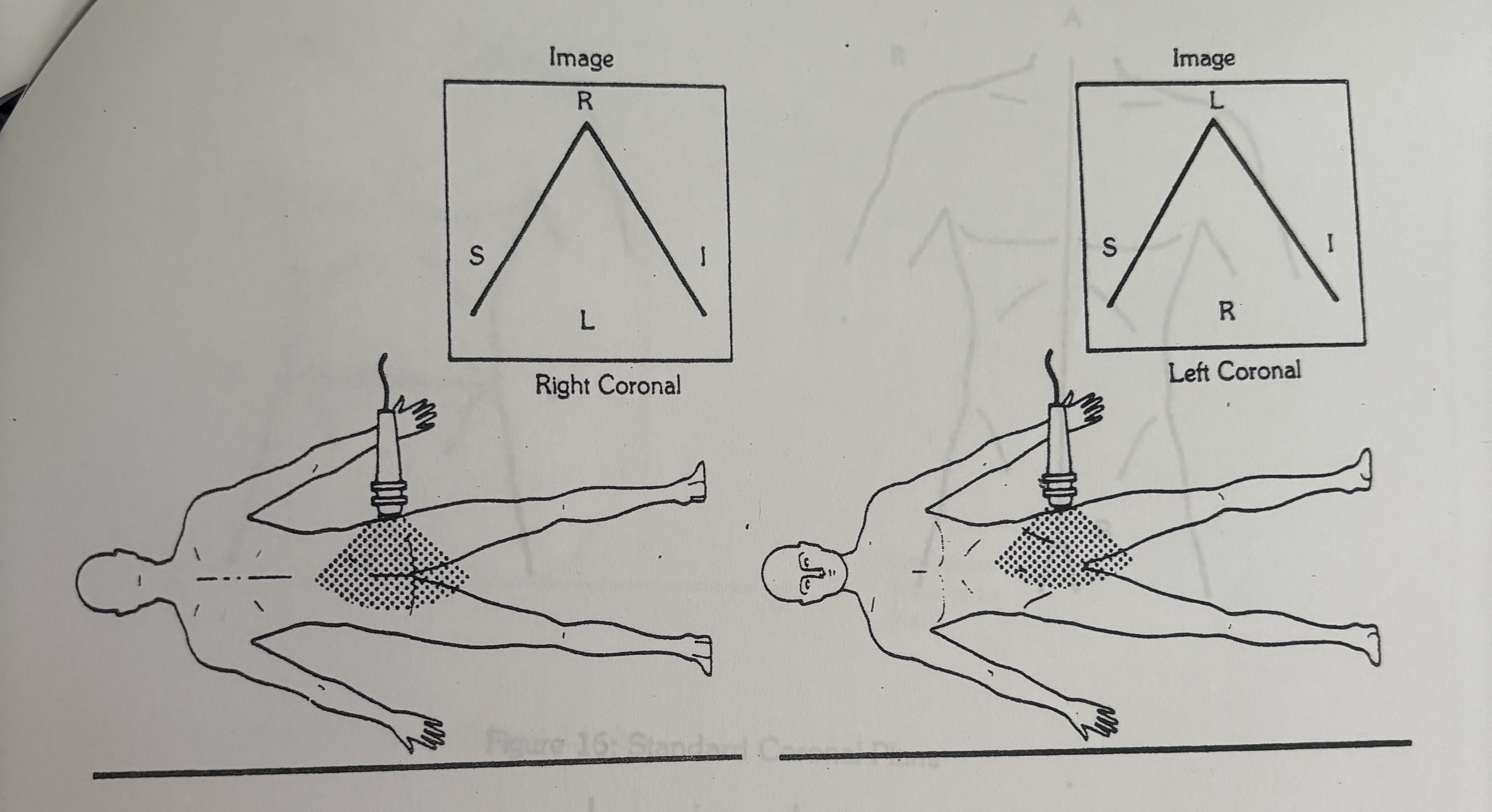 <p>Right side of monitor during lateral coronal scan</p>