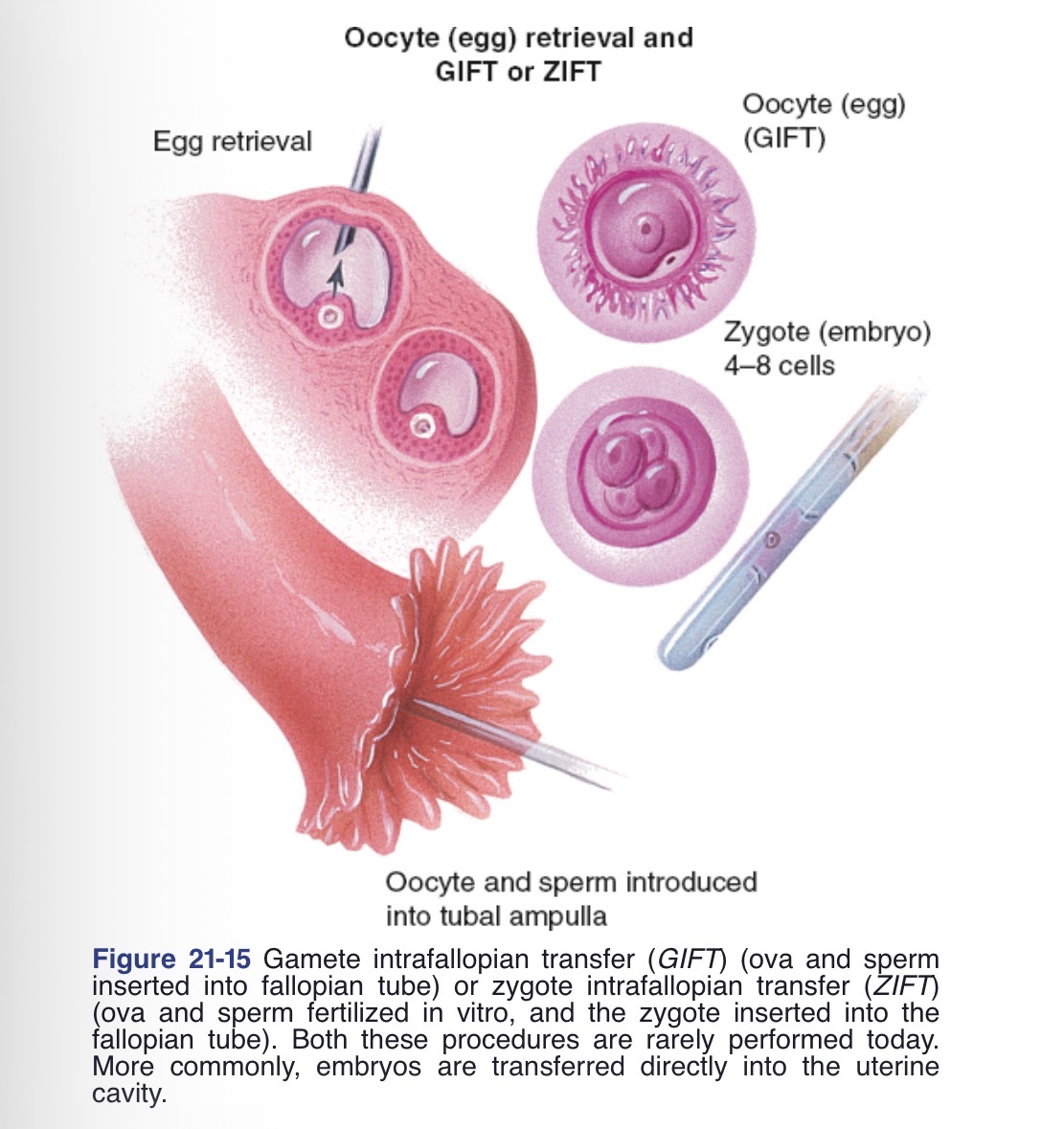 <p>Gamete intrafallopian tube transfer (GIFT)</p>