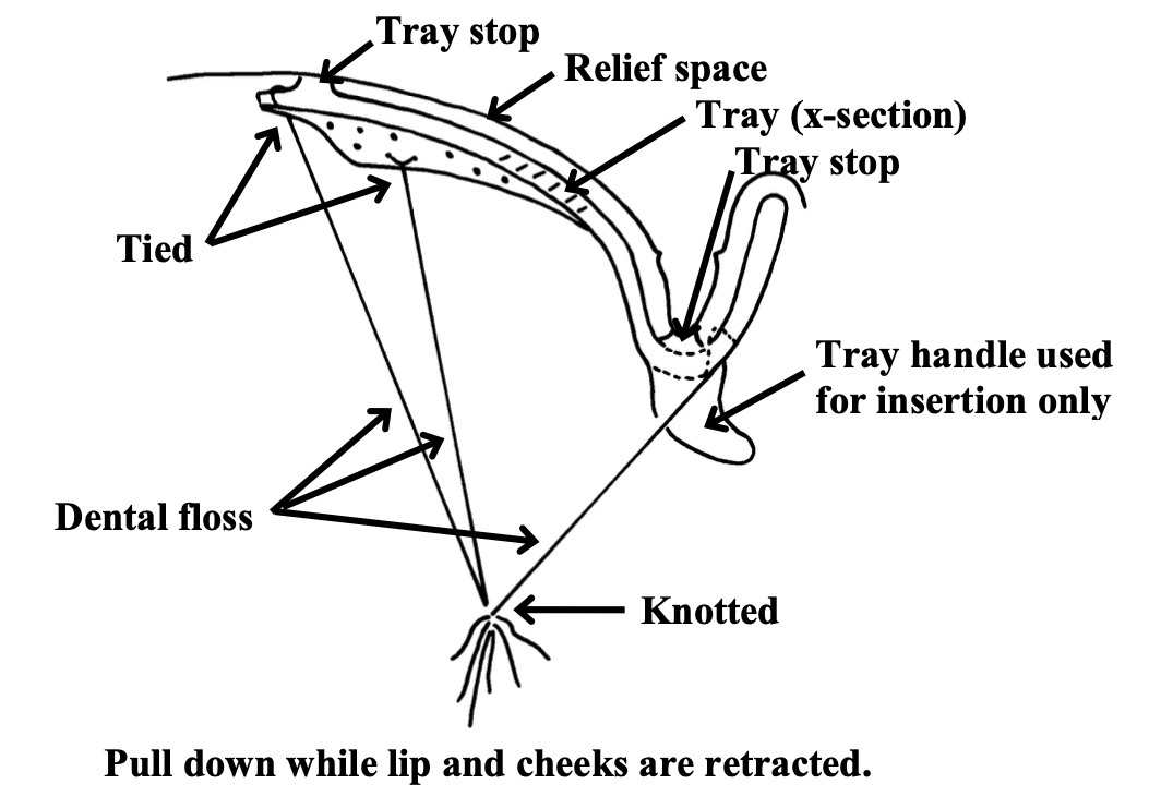 <p>Removing the impression from the mouth is difficult because alginate covers the borders, and custom tray handles are slippery. What can you do to help easily remove the tray?</p>