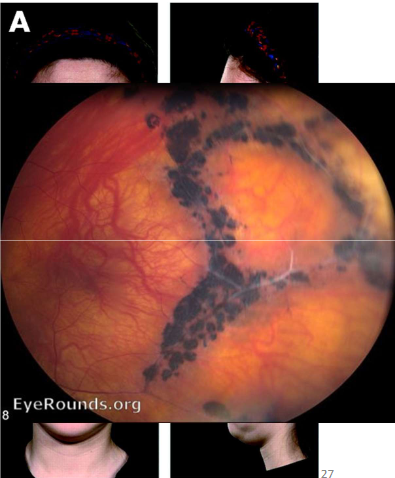 <p>Name the condition</p>