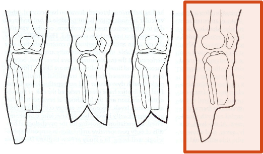 <p>posterior; because the thick gastroc and soleus will cover the residual limb and the incision goes on the anterior end away from pressure/WB</p>