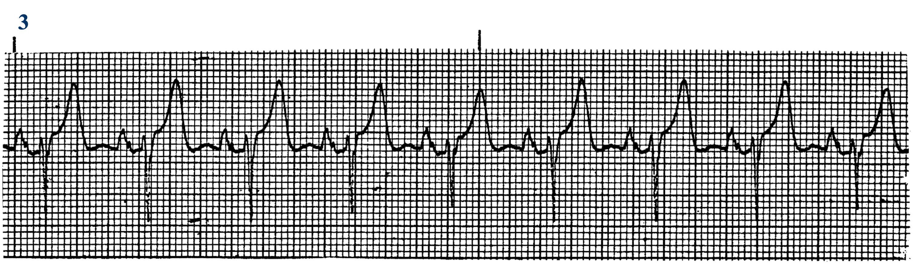 <p>What ECG is this? </p>