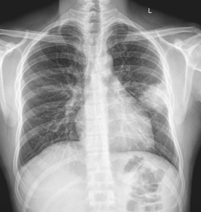 <p>Mail 25-year-old has a chief complaint of throat, pain, body ache, fever and left side of chest pain for two days no history of breathing difficulty or cough. Pain is not radiating to the left arm or neck. patient has poetic chest pain that is a stabbing feeling and is worse on inspiration</p>