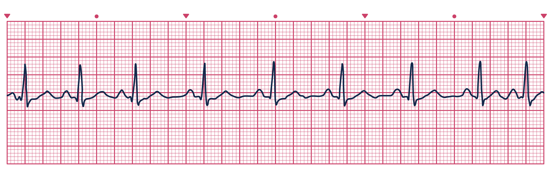 <p>Rate: 60-100</p><p>Regularity: depends on respiration </p>