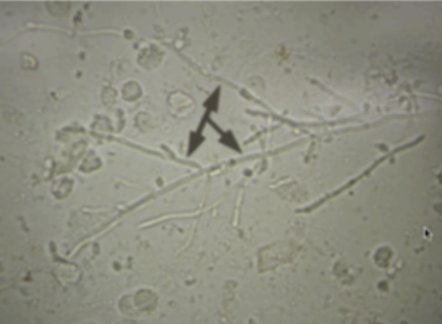 <p>⚠️10.These structures are seen in KOH wet mount taken from a vaginal discharge. These type of infections is best treated by the use of: A.Ceftriaxone 250 mg IM B.Fluconazole 150 mg single dose C.Doxycycline 100 mg BID x 10 days D.Metronidazole 400 mg single oral dose</p>