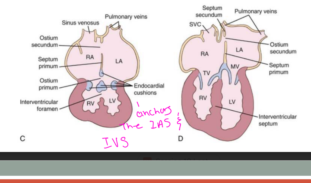 <p>AVSDs result from abnormal development of the <strong>endocardial cushions</strong>.</p><p>The endocardial cushions help form:</p><ol><li><p>Atrial septum</p></li><li><p>Ventricular septum</p></li><li><p>Septal leaflet of the tricuspid valve</p></li><li><p>Anterior leaflet of the mitral valve</p></li></ol><p></p>