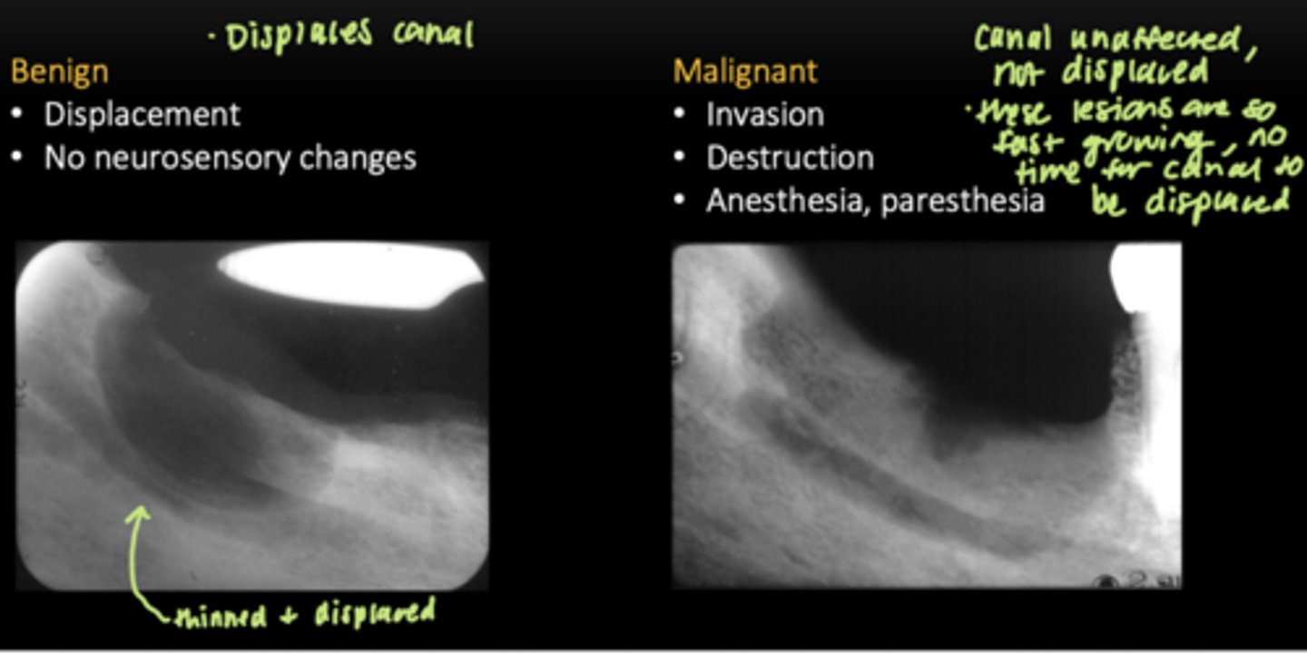 <p>Benign: </p><p>- Displacement </p><p>- No neurosensory changes </p><p>Malignant:</p><p>- Invasion </p><p>- Destruction </p><p>- Anesthesia, paresthesia </p>
