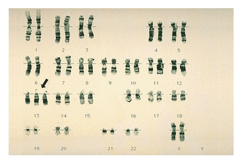 <p><strong>trisomy 13</strong></p><p>most fetuses die before term</p><p>5% live to age 3</p><p>45% die within first month</p><p>serious eye, brain, and circulatory defects, malformations, kidney/heart defects</p>