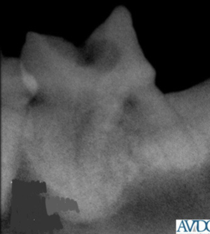 <p>Which tooth resorption stage?</p>