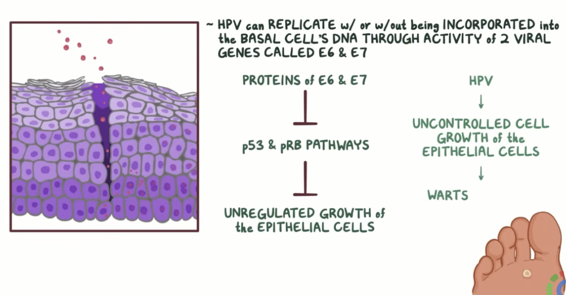 <ul><li><p><strong>Chronic infection and <mark data-color="yellow" style="background-color: yellow; color: inherit;">integration of viral DNA binding proteins encoded by the E6/E7 genes</mark> into cellular DNA; only viral genes expressed in HPV+ cancer cells</strong></p></li><li><p><strong> E6/E7 expression transforms primary keratinocytes and </strong><span style="color: red;"><strong>causes cancer in transgenic animals</strong></span></p></li><li><p><strong>Inhibition of E6/E7 <mark data-color="green" style="background-color: green; color: inherit;">inhibits the growth of HPV+ cancer cells </mark>and results in senescence</strong></p></li></ul><p></p>
