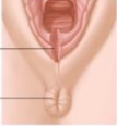 <p>Perineal laceration limited to the perineal skin</p>