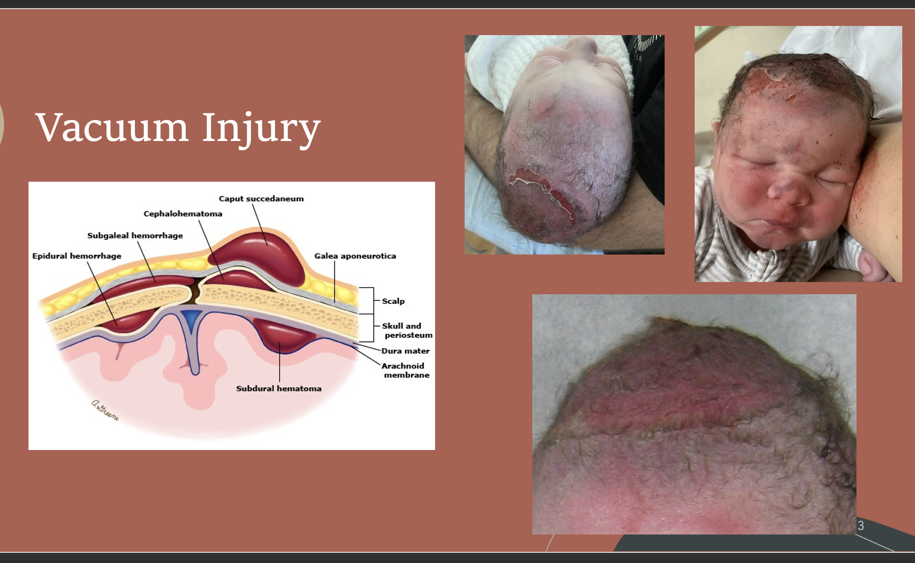 <p>Vacuum Injury</p>