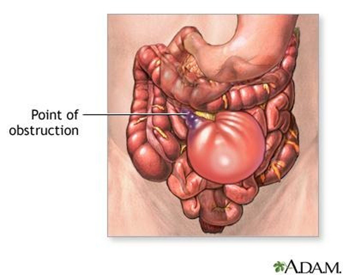 <p>Partial or complete blockage of small or large intestine</p>