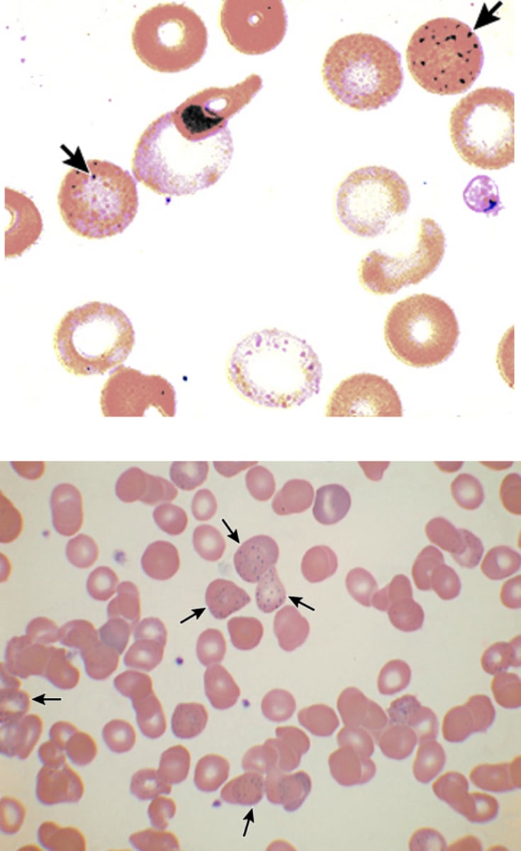 <p>Lead poisoning, Megaloblastic anemia, Thalassemias, and Alcohol related liver disease</p>