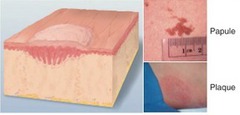 <p>a small, solid, raised skin bump that measures less than one centimeter wide</p>