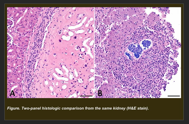 <p>A cat presents with acute renal failure following suspected vascular thromboembolism. Post-mortem examination shows a pale, wedge-shaped cortical lesion with a depressed capsular surface (from Session 1A). Histologic examination of the pale region reveals:</p><p>- Dead cells with preserved outlines of tissue architecture -- tubule outlines and glomerular shapes are still recognizable</p><p>- Ghost cell forms visible where tubular epithelium has died</p><p>- Nuclear changes: pyknosis, karyorrhexis, karyolysis in affected cells</p><p>- Dense neutrophilic infiltration at the margin of the lesion</p><p>- Intact surrounding kidney architecture outside the lesion boundary</p><p>A second region from the same kidney, adjacent to a focus of suppurative bacterial infection, shows:</p><p>- Complete loss of tissue architecture -- no cell outlines, no tubule shapes recognizable</p><p>- Liquefied, granular, structureless debris filling the area</p><p>- Dense neutrophilic infiltration throughout the debris</p><p></p><p><strong>Which explanation best accounts for the DIFFERENCE in morphologic appearance between the two necrotic regions?</strong></p><p>a. Region 1 (pale wedge) shows coagulative necrosis where ischemic protein denaturation preserves the ghost architecture of dead cells. Region 2 (bacterial focus) shows liquefactive necrosis where proteolytic enzymes from neutrophils and bacteria overwhelm any structural preservation, converting the dead tissue to liquid debris</p><p>b. Region 1 shows reversible injury with preserved architecture, while Region 2 shows irreversible injury with complete architectural loss</p><p>c. Region 1 shows apoptosis (organized cell death with preserved architecture), while Region 2 shows necrosis (disorganized death with architectural loss)</p><p>d. Region 1 and Region 2 represent the same process at different time points -- Region 2 is simply more advanced necrosis that has had longer to develop</p>
