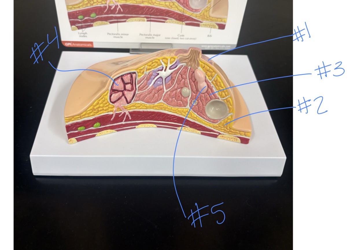 <p>fibroadenoma </p>