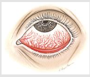 <p>diffuse dialation of conjunctival vessels w/ redness that tends to MAX peripherally</p><p>Mild discomfort, vision fine, discharge watery/mucoid/mucopurulent</p>