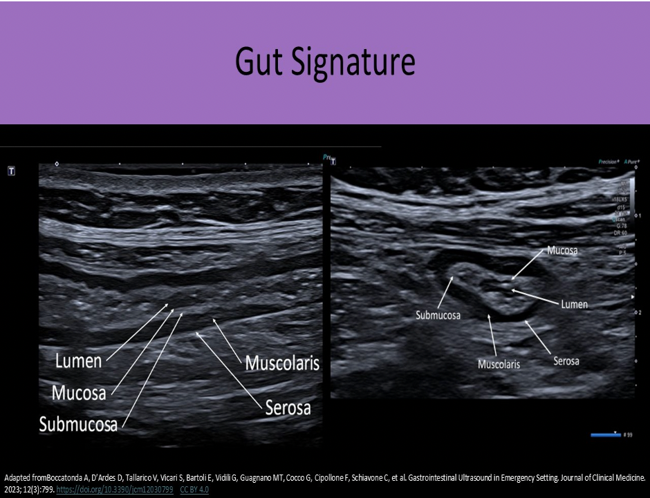 <p>B. Deep mucosa, muscularis propia</p><p>The Gut Signature (Sonographically):</p><p class="p1">Superficial Mucosa - epithelial lining (and lumen); echogenic</p><p class="p1">Deep Mucosa-- Consists of loose connective tissue and muscularis mucosa;</p><p class="p1">hypoechoic</p><p class="p1">Submucosa - echogenic</p><p class="p1">Muscularis propia-- inner circular fibers and outer longitudinal fibers;</p><p class="p1">hypoechoic</p><p class="p1">Serosa or Adventitia - echogenic</p>