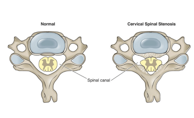 <p><em>Narrowing of the canal squeezes spinal cord (Normal spacing of canal and cord is </em><strong><em>2.5mm on sides & 1mm front/back</em></strong><em>) </em></p><ul><li><p><strong>Pain</strong> : Bilateral arm pain</p></li><li><p><strong>Causes</strong> : bony overgrowth from OA or aging, calcification of ligaments of the spinal canal, scoliosis, disc herniations </p></li><li><p><strong>Symptoms</strong> : Bilateral arm pain, fatigue, numbness/tingling, weakness, abnormal reflexes/sensory loss </p><ul><li><p><em>Cervical Myelopathy</em><strong> </strong>: Disruption of nerves impulses through neck & affects LE strength, gait, and bowel/bladder</p></li></ul></li></ul><p></p>