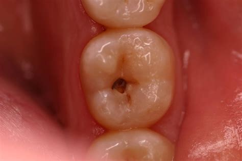 <p>Dental caries</p>