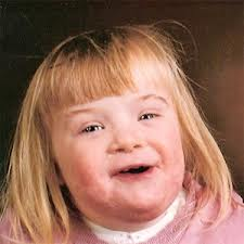 <p>- Down Syndrome</p>