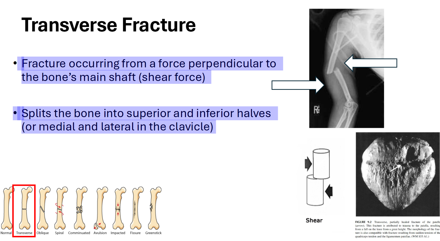<p>Transverse Fracture</p>