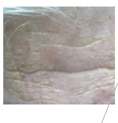 <p>Yellowish white macules (<1cm flat skin color change) on sun-exposed skin, ESP forehead</p>