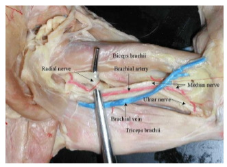 <p>Provides motor innervation to part of the forearm and majority of the hand.</p>