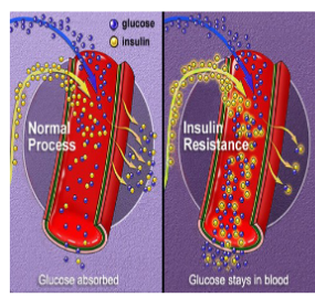 <ul><li><p>reduced production of insulin or inability of insulin to bind to its receptors (called insulin resistance)</p></li><li><p>develops during adulthood</p></li><li><p>strongly associated with obesity</p></li><li><p>controlled through diet and exercise</p></li><li><p>oral drugs can be used to increase insulin production or encourage binding to its receptors</p></li></ul><p></p>